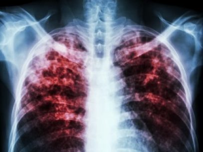 Ziua Mondială de Combatere a Tuberculozei. „Spre deosebire de alte țări din regiune, R. Moldova nu a înregistrat în această perioadă o creștere e deceselor”