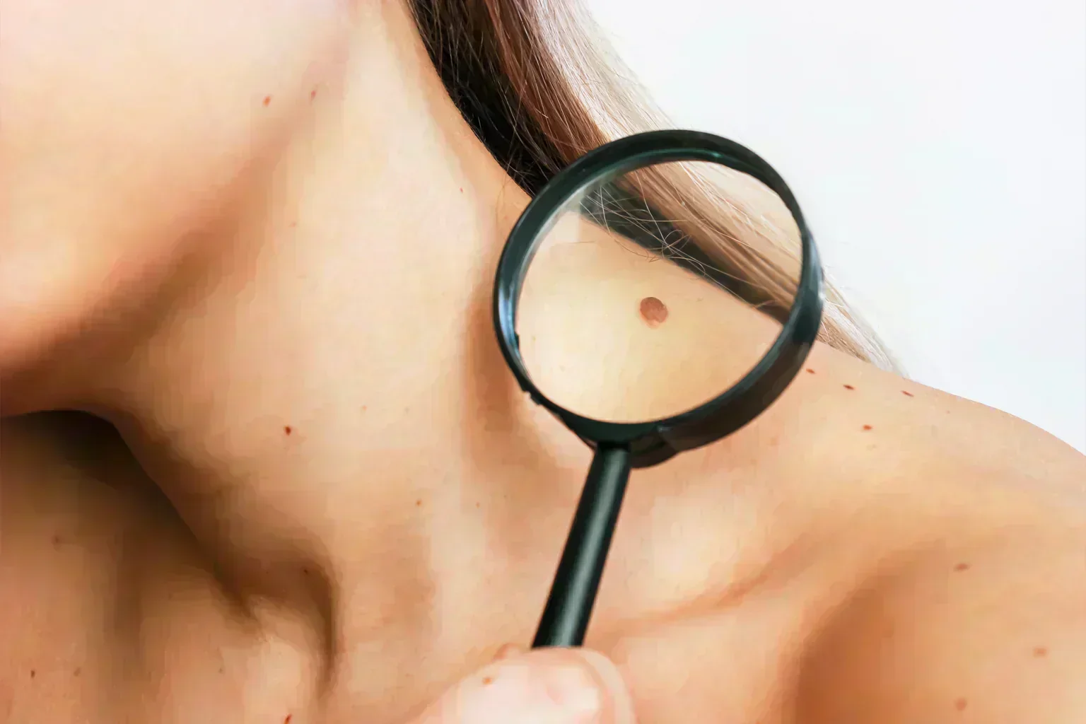 2026: Cancerul de piele poate fi prevenit! Fii în 